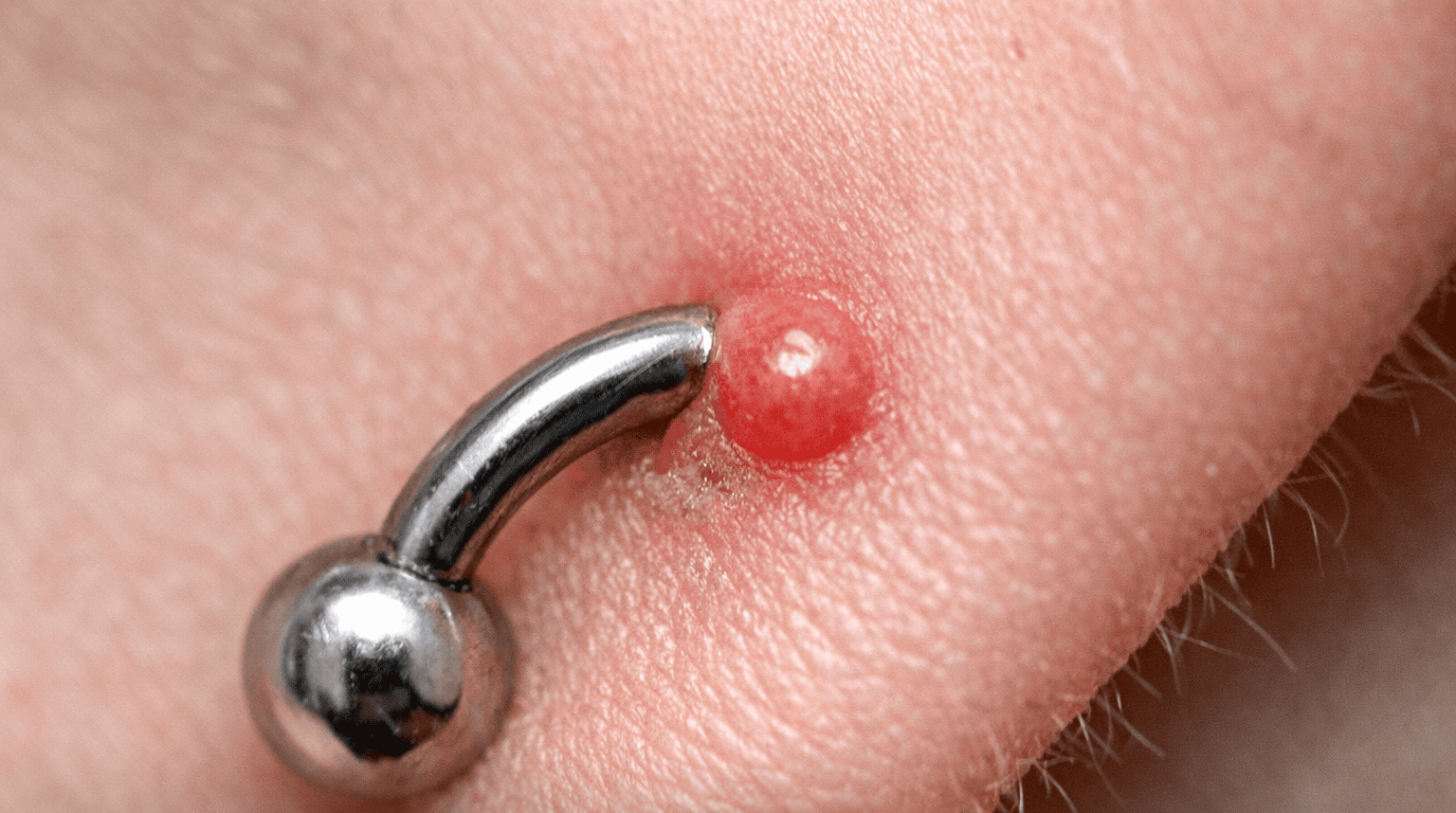 Bollicina accanto al piercing durante la fase di guarigione
